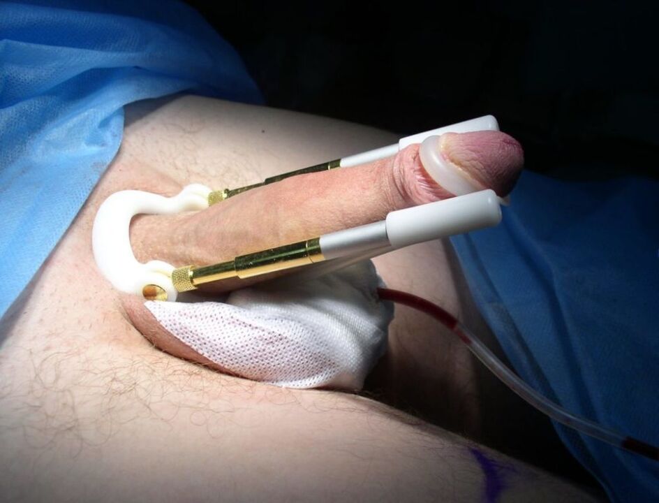 Zgjatës pas operacionit të zmadhimit të penisit