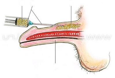 zmadhimi i penisit me injeksion